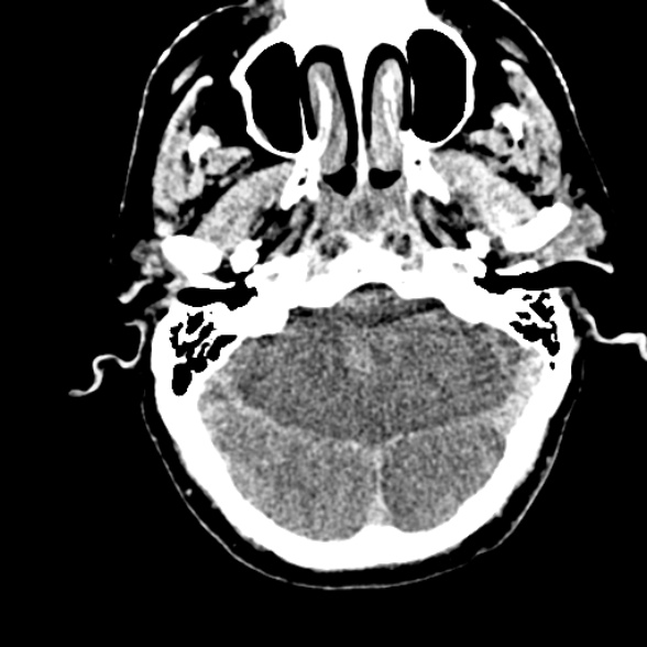 File:Basilar artery thrombosis (Radiopaedia 53351-59352 Axial non-contrast 33).jpg