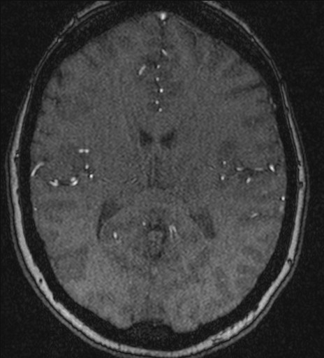 Basilar tip aneurysm (Radiopaedia 26504-26632 MRA 142).jpg