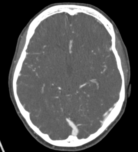 Basilar tip aneurysm with coiling (Radiopaedia 53912-60086 A 69).jpg