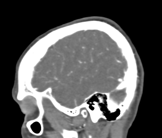 Basilar tip aneurysm with coiling (Radiopaedia 53912-60086 C 19).jpg