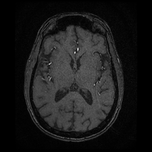 Basilar top and left middle cerebral artery aneurysm (Radiopaedia 61965-70031 Axial MRA 90).jpg