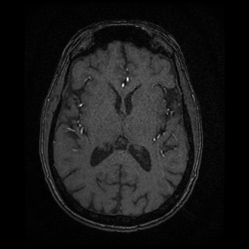 Basilar top and left middle cerebral artery aneurysm (Radiopaedia 61965-70031 Axial MRA 91).jpg