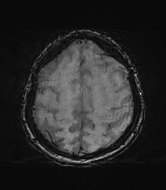 File:Behavioral variant frontotemporal dementia and late onset schizophrenia (Radiopaedia 52197-58083 Axial SWI 59).png