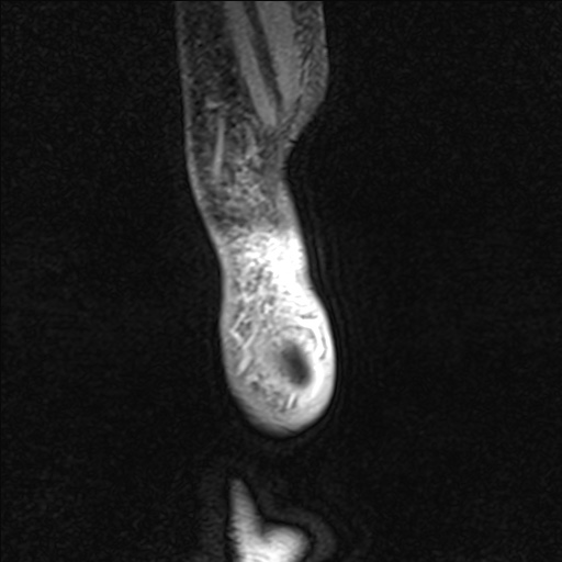 File:Bilateral Achilles tendon complete tear (Radiopaedia 81344-95051 Sagittal WE - Left 105).jpg