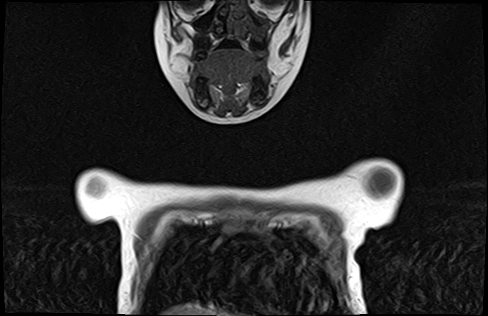 File:Bilateral Sprengel deformity with Klippel-Feil syndrome (Radiopaedia 66395-75650 Coronal T1 1).jpg