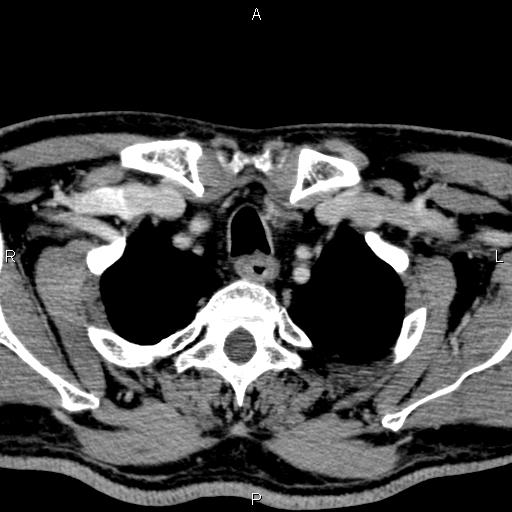 Bilateral Warthin tumors (Radiopaedia 84034-99263 Axial With contrast 64).jpg