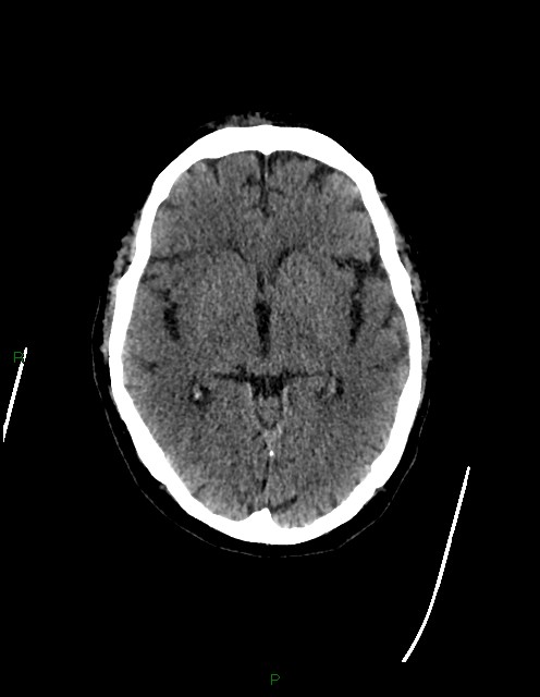 Bilateral acute middle cerebral artery territory infarcts (Radiopaedia 77319-89401 Axial non-contrast 40).jpg