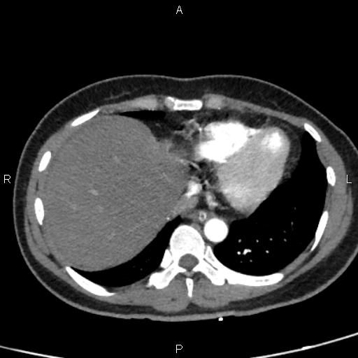 Bilateral adrenal gland hyperenhancement in pancreatitis (Radiopaedia 86642-102753 B 10).jpg