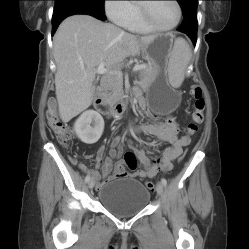 Bilateral adrenal granulocytic sarcomas (chloromas) (Radiopaedia 78375-91007 B 40).jpg