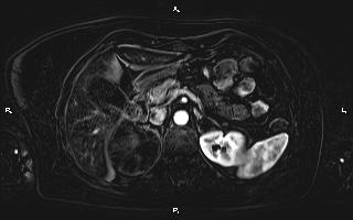 Bilateral adrenal myelolipoma (Radiopaedia 63058-71537 I 36).jpg