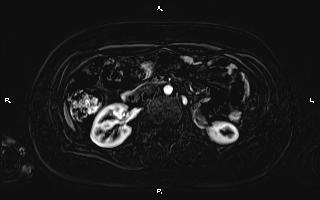 Bilateral adrenal myelolipoma (Radiopaedia 63058-71537 I 53).jpg