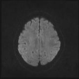 File:Bilateral basal ganglia and thalamic T1 hyperintensities (Radiopaedia 19764-19802 Axial DWI 33).jpg