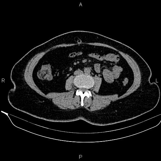 Bilateral benign adrenal adenomas (Radiopaedia 86912-103124 Axial non-contrast 64).jpg
