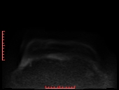 File:Bilateral breast implant rupture (Radiopaedia 24761-25027 DWI 32).jpg