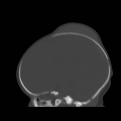 File:Bilateral cephalohematomas and subdural hematomas (Radiopaedia 26778-26929 Sagittal bone window 17).jpg
