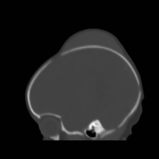 File:Bilateral cephalohematomas and subdural hematomas (Radiopaedia 26778-26929 Sagittal bone window 31).jpg