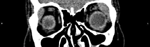 File:Bilateral enlargement of lacrimal glands - sarcoidosis (Radiopaedia 62627-70921 Coronal non-contrast 12).jpg
