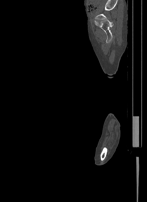 Bilateral fibular hemimelia type II (Radiopaedia 69581-79491 Sagittal bone window 58).jpg