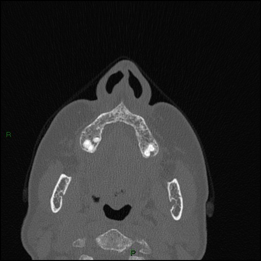 Bilateral frontal mucoceles (Radiopaedia 82352-96454 Axial bone window 245).jpg