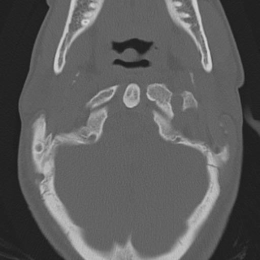 Bilateral locked facets (Radiopaedia 33850-35016 Axial bone window 5).png