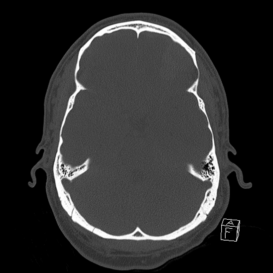 File:Bilateral occipital condyle fracture (type 2) (Radiopaedia 87675-104089 Axial bone window 45).jpg