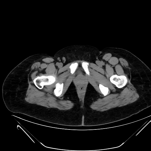 Bilateral ovarian mature cystic teratomas (Radiopaedia 79373-92457 Axial non-contrast 95).jpg
