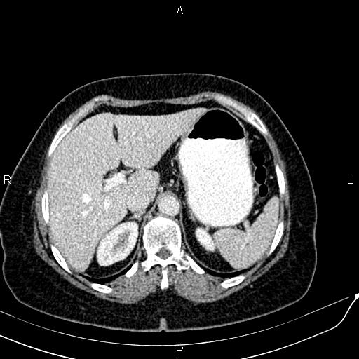 Bilateral ovarian serous cystadenocarcinoma (Radiopaedia 86062-101989 B 25).jpg