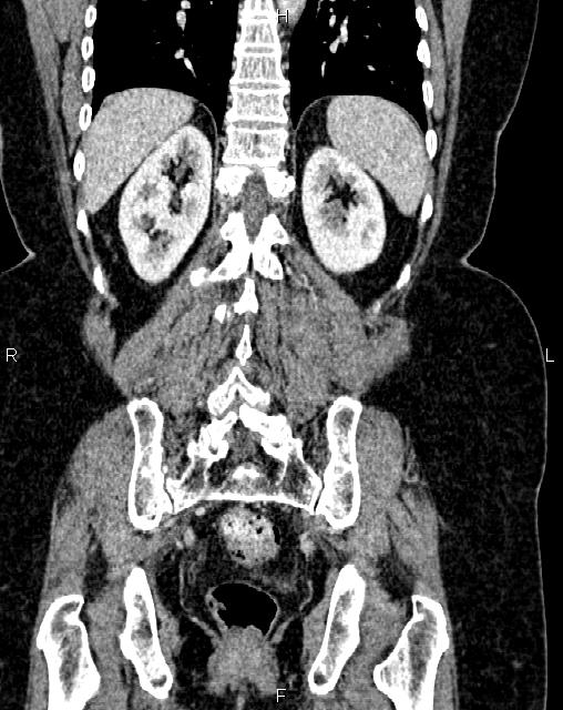 Bilateral ovarian serous cystadenocarcinoma (Radiopaedia 86062-101989 D 39).jpg