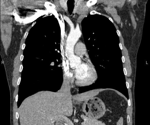 Bilateral pulmonary AVM (Radiopaedia 83134-97505 C 34).jpg