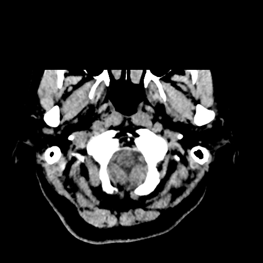 Bilateral subacute subdural hematoma (Radiopaedia 69240-79018 Axial non-contrast 3).jpg
