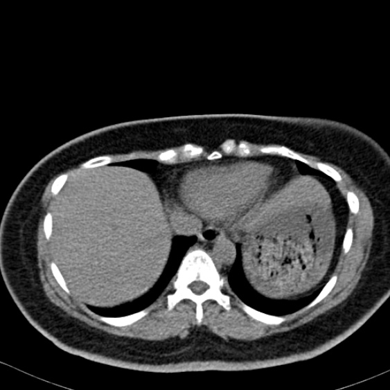 Bilateral ureteric stents (Radiopaedia 48795-53825 Axial non-contrast 1).jpg