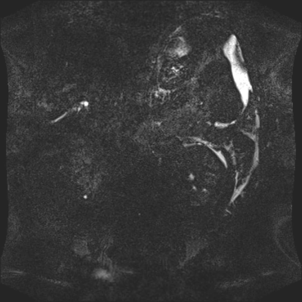 Biliary pancreatitis (Radiopaedia 72289-82824 Coronal 3D T2 87).jpg