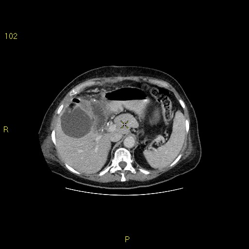 File:Biloma with drainage into the colon (Radiopaedia 20032-20068 A 8).jpg