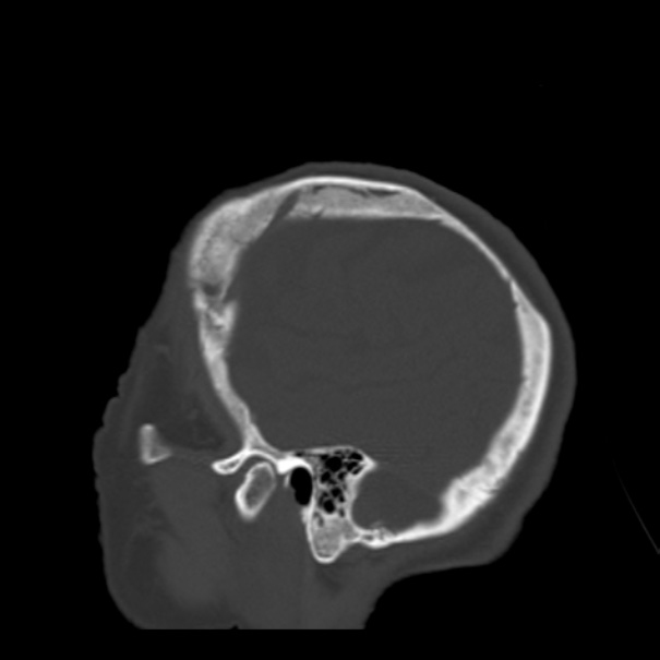 Biparietal osteodystrophy (Radiopaedia 46109-50463 Sagittal bone window 18).jpg