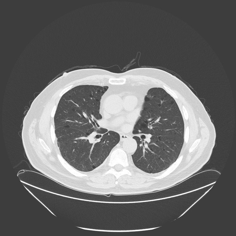 Birt-Hogg-Dubé syndrome (Radiopaedia 52578-58491 Axial lung window 32).jpg