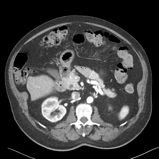 File:Bladder papillary urothelial carcinoma (Radiopaedia 48119-52951 A 18).png