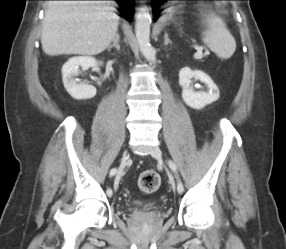 File:Bladder papillary urothelial carcinoma (Radiopaedia 48119-52951 C 42).png