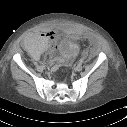 Bladder rupture post renal biopsy (Radiopaedia 30863-31572 Axial non-contrast 66).jpg