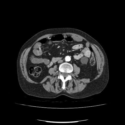 File:Bladder tumor detected on trauma CT (Radiopaedia 51809-57609 A 125).jpg