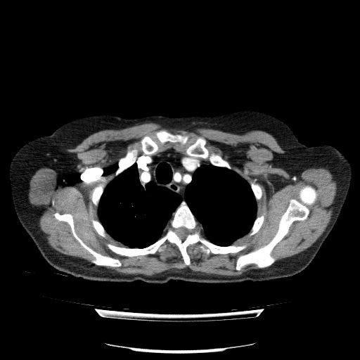 Bladder tumor detected on trauma CT (Radiopaedia 51809-57609 A 21).jpg