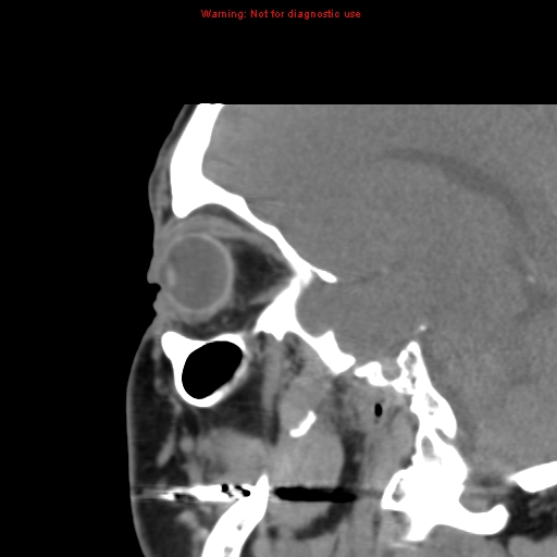 File:Blowout fracture with inferior rectus entrapment (Radiopaedia 12418-12673 C 7).jpg
