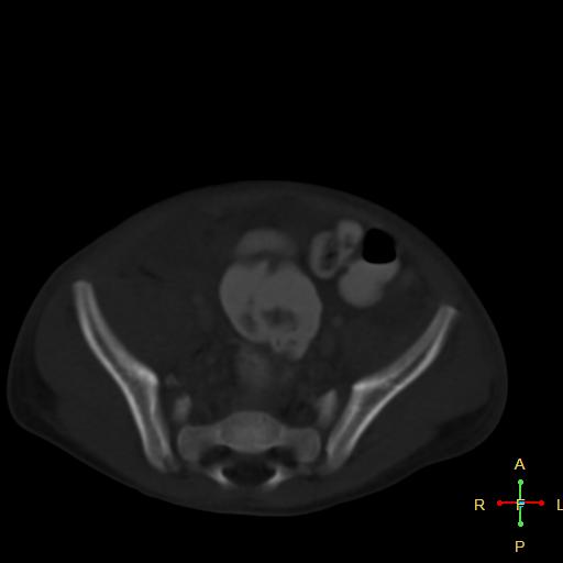 File:Blunt abdominal trauma (Radiopaedia 24780-25044 Axial bone window 10).jpg