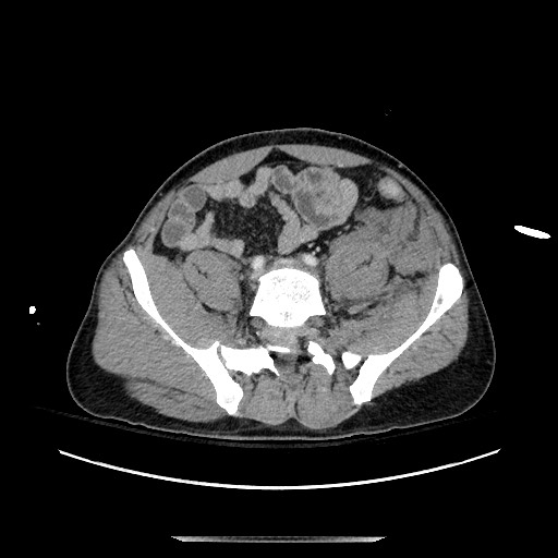 Blunt abdominal trauma with solid organ and musculoskelatal injury with active extravasation (Radiopaedia 68364-77895 A 112).jpg