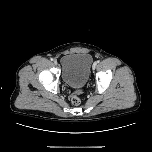 Blunt abdominal trauma with solid organ and musculoskelatal injury with active extravasation (Radiopaedia 68364-77895 A 140).jpg