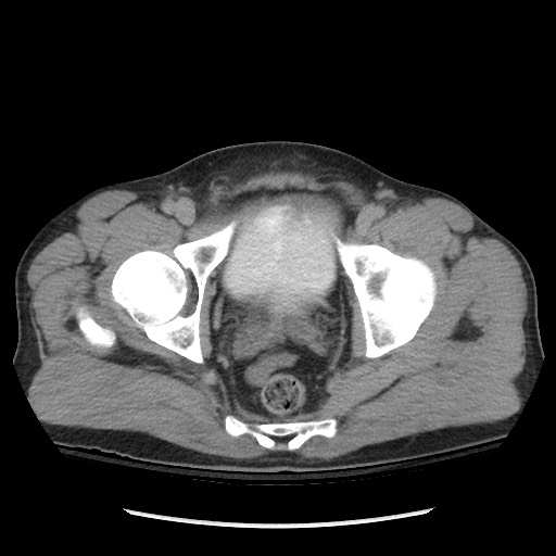 Blunt abdominal trauma with solid organ and musculoskelatal injury with active extravasation (Radiopaedia 68364-77895 Axial C+ delayed 128).jpg