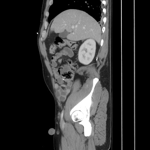 File:Blunt abdominal trauma with solid organ and musculoskelatal injury with active extravasation (Radiopaedia 68364-77895 C 47).jpg