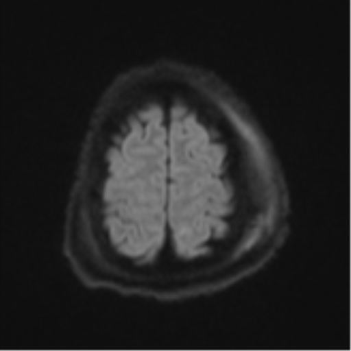 Blunt cerebrovascular injury (Radiopaedia 53682-59745 Axial DWI 56).png
