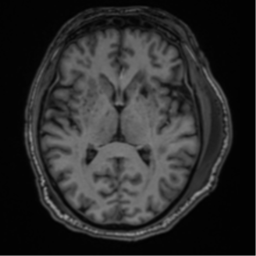 File:Blunt cerebrovascular injury (Radiopaedia 53682-59745 Axial T1 17).png