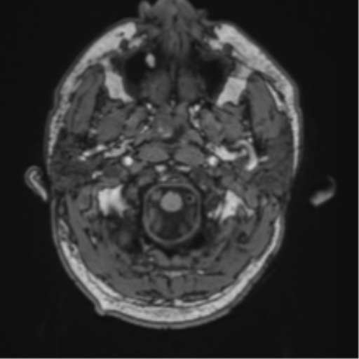 File:Blunt cerebrovascular injury (Radiopaedia 53682-59745 Axial T1 3).png