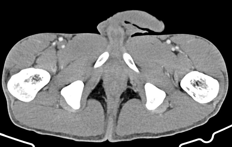 Blunt injury to the small bowel (Radiopaedia 74953-85987 A 205).jpg